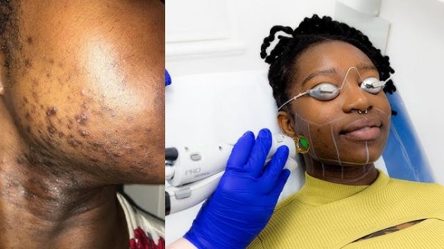 What to Know About Advanced Hair Removal Methods: Expert Tips